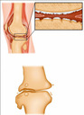Mistletoe Injection for Osteoarthritis