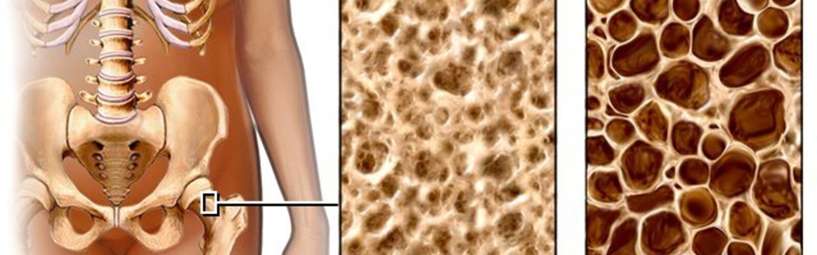 Will Calcium reverse Osteoporosis?
