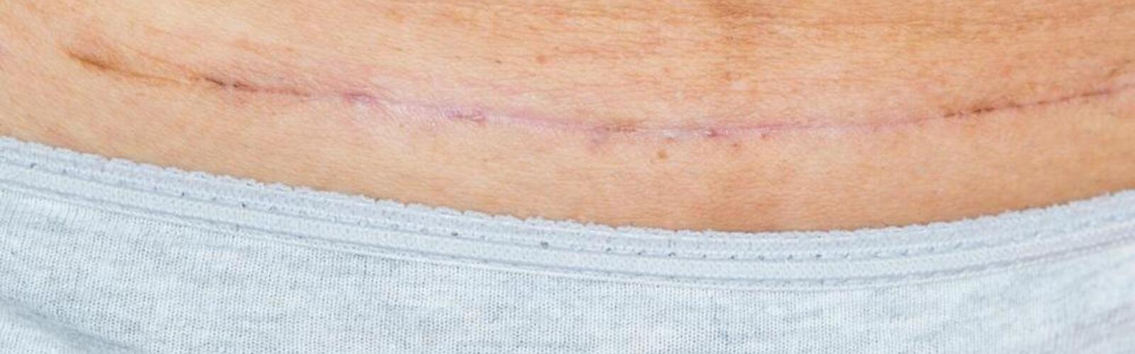 What to do if you have a C-section