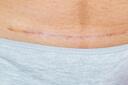 What to do if you have a C-section