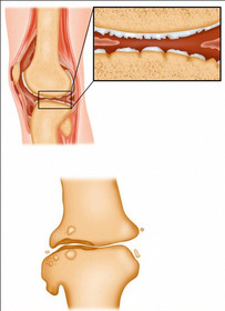 Photo for Osteoarthritis